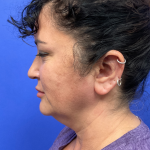 Facelift Before & After Patient #9305