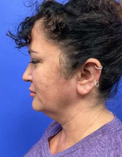 Facelift Before & After Patient #9305