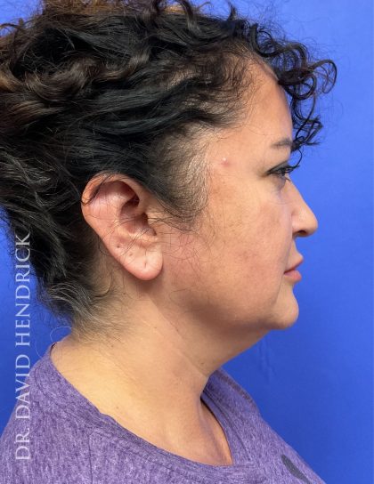Facelift Before & After Patient #9306