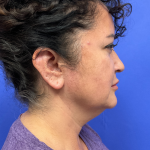 Neck Lift Before & After Patient #9306