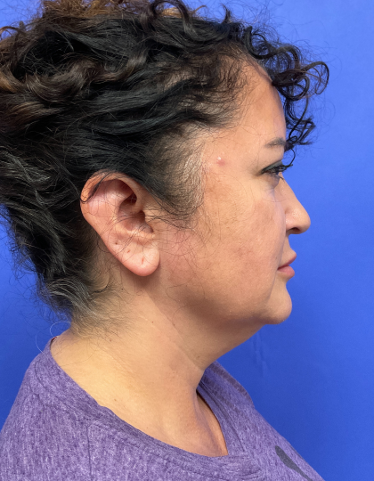 Neck Lift Before & After Patient #9306