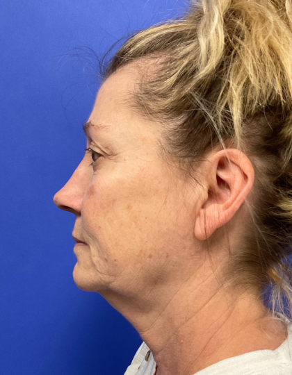 Facelift Before & After Patient #9362