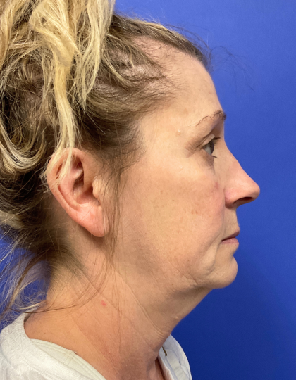 Neck Lift Before & After Patient #9363