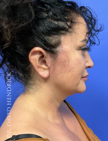 Facelift Before & After Patient #9306