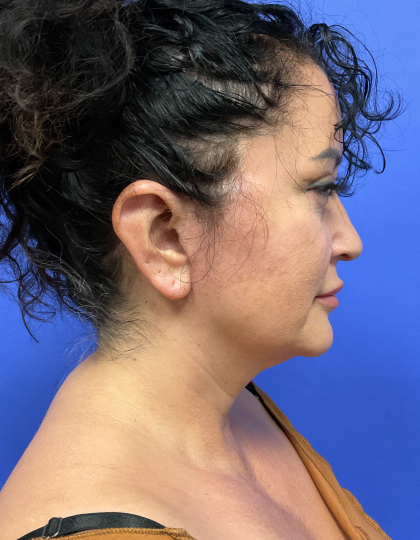 Neck Lift Before & After Patient #9306