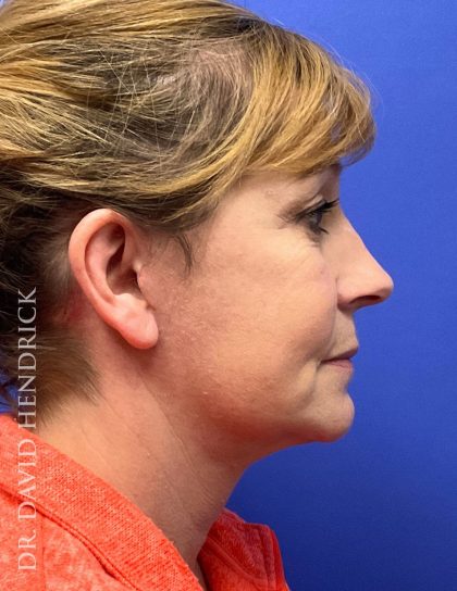 Brow Lift Before & After Patient #9363