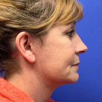 Neck Lift Before & After Patient #9363