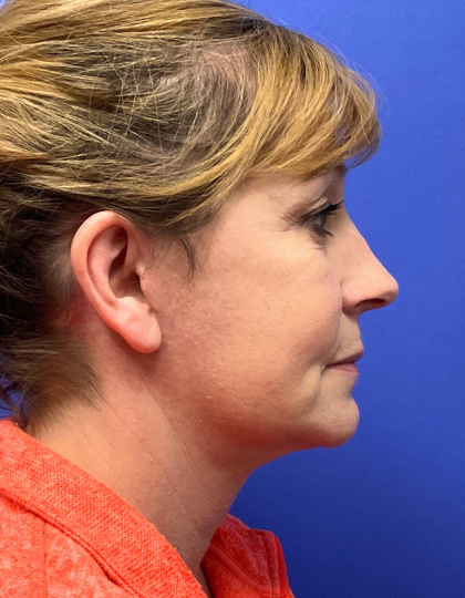 Neck Lift Before & After Patient #9363