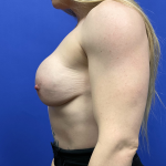 Breast Augmentation Before & After Patient #9302