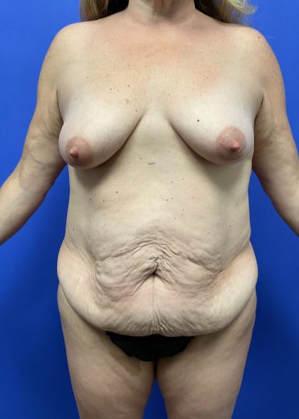 Mastopexy Before & After Patient #9645