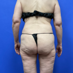 Post Weight Loss Before & After Patient #9559