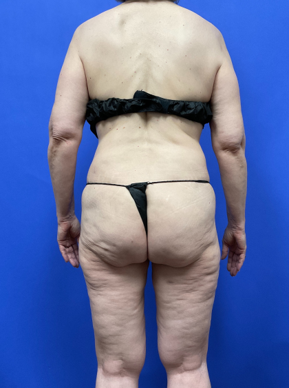 Post Weight Loss Before & After Patient #9559