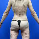 Post Weight Loss Before & After Patient #9578