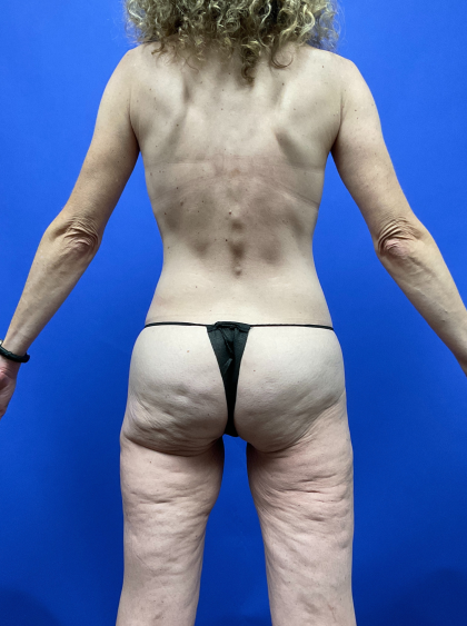 Post Weight Loss Before & After Patient #9578