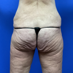 Post Weight Loss Before & After Patient #9579