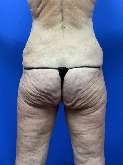 Post Weight Loss Before & After Patient #9579