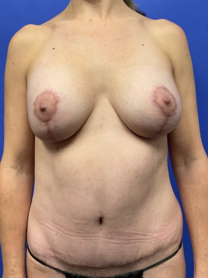 Mastopexy Before & After Patient #9646