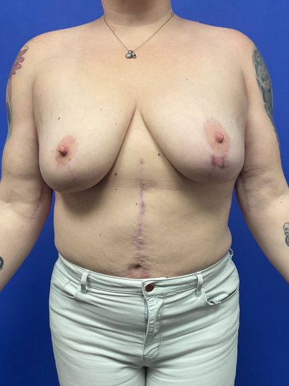 Mastopexy Before & After Patient #9656