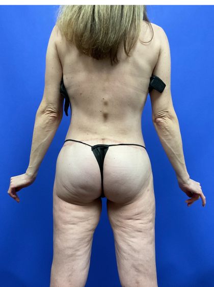 Post Weight Loss Before & After Patient #9578