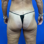 Post Weight Loss Before & After Patient #9579