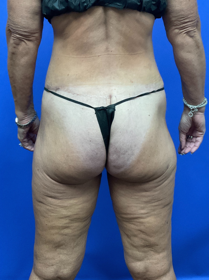 Post Weight Loss Before & After Patient #9579