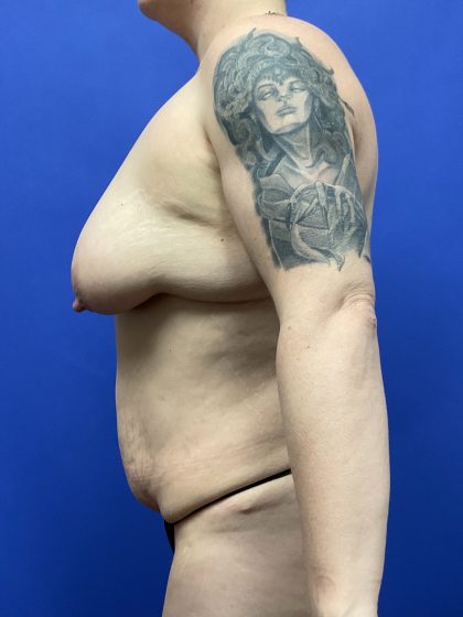 Mastopexy Before & After Patient #9656