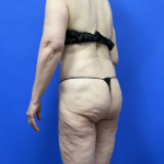 Post Weight Loss Before & After Patient #9559