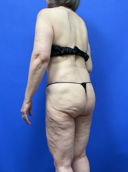 Post Weight Loss Before & After Patient #9559