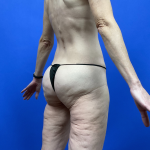Post Weight Loss Before & After Patient #9578
