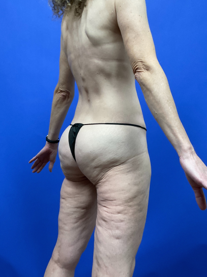 Post Weight Loss Before & After Patient #9578
