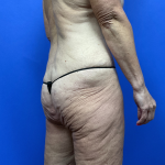 Post Weight Loss Before & After Patient #9579
