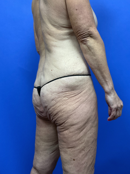 Post Weight Loss Before & After Patient #9579
