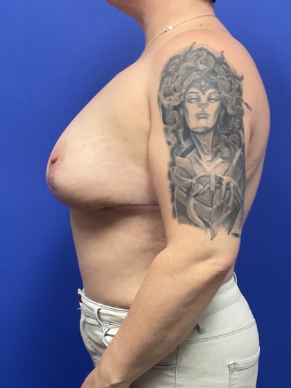 Mastopexy Before & After Patient #9656