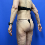 Post Weight Loss Before & After Patient #9559