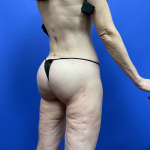 Post Weight Loss Before & After Patient #9578