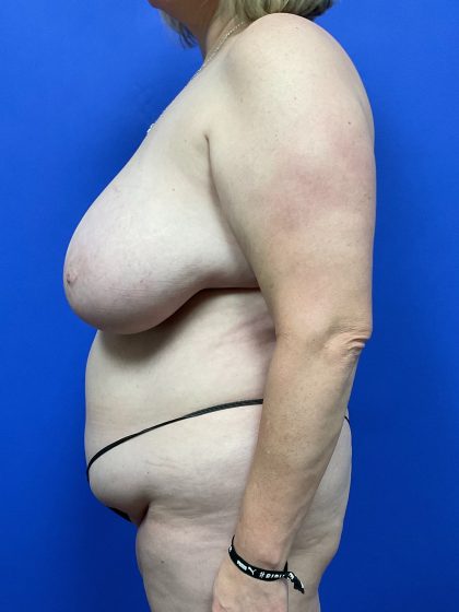 Mommy Makeover Before & After Patient #9631