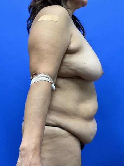 Mastopexy Before & After Patient #9659