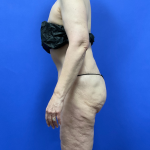 Post Weight Loss Before & After Patient #9559
