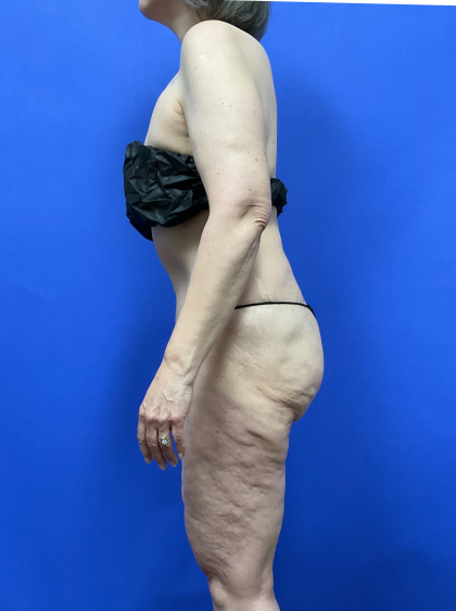 Post Weight Loss Before & After Patient #9559