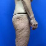 Post Weight Loss Before & After Patient #9579