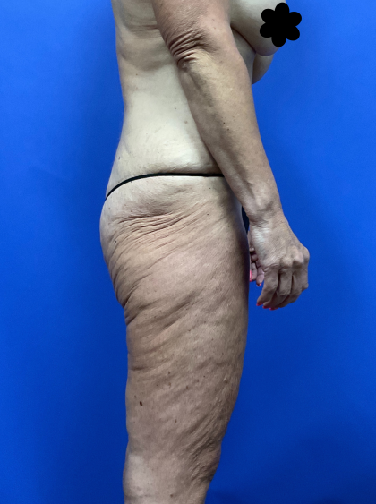 Post Weight Loss Before & After Patient #9579