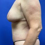 Mommy Makeover Before & After Patient #9631