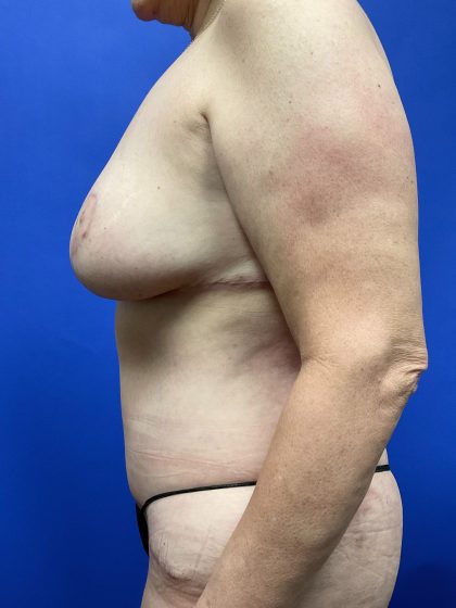 Mommy Makeover Before & After Patient #9631