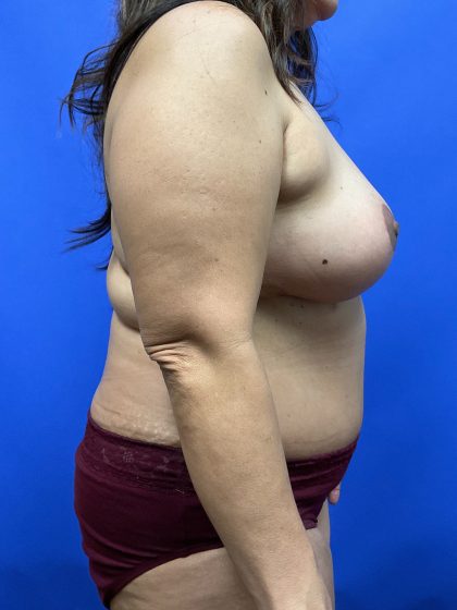 Mastopexy Before & After Patient #9659