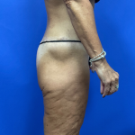 Post Weight Loss Before & After Patient #9579