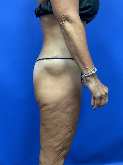 Post Weight Loss Before & After Patient #9579