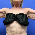 Arm Lift Before & After Patient #9821