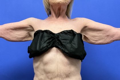 Mini Arm Lift Before & After Patient #9821