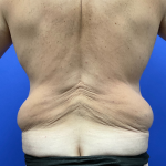 Post Weight Loss Before & After Patient #9776