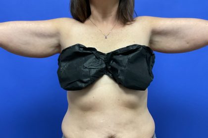 Arm Lift Before & After Patient #9826